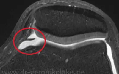 MRT-Aufnahme eines Knies mit rot markiertem Plica-Syndrom, wie es bei Liebscher & Bracht bekannt ist.