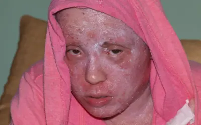 Osoba w różowej bluzie z kapturem, z zaczerwienioną, łuszczącą się skórą twarzy, która może być leczona kremem Bedicort G.