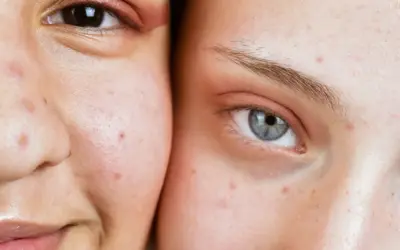 Visages de deux personnes montrant des imperfections cutanées, possiblement des maladies de peau dues au stress.