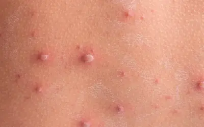 Początki ospy na skórze: drobne, czerwone krostki i pęcherzyki, niektóre z białym czubkiem.