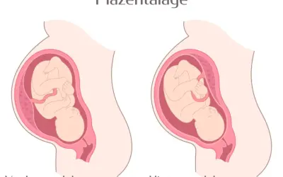 Zwei Darstellungen einer Schwangerschaft: Links eine vorderwand plazenta, rechts eine hinterwandplazenta. Der Fötus ist in beiden Fällen gut erkennbar.