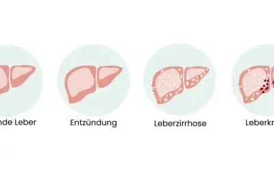 Illustration zeigt gesunde Leber, Entzündung, Leberzirrhose und Leberkrebs. Frühe Anzeichen von Leberkrebs sind oft unspezifisch.