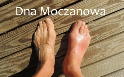Podagra: Co to za choroba? Objawy, leczenie i skuteczna dieta
