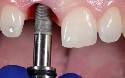 Zabieg wszczepienia implantu dentystycznego w szczękę. Widoczne narzędzie stomatologiczne i fragment implantu.