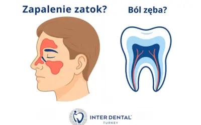Zapalenie zatok czy pulsujący ból zęba? Ilustracja porównuje objawy zapalenia zatok z budową zęba.