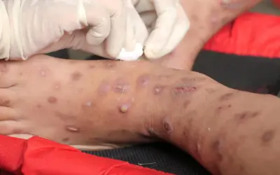 Gambe con lesioni cutanee, forse trattate con scabbia rimedi della nonna. Mani con guanti applicano un trattamento.