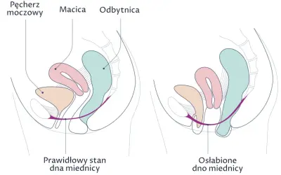 Porównanie prawidłowego i osłabionego dna miednicy. Na drugim obrazku widać obniżenie narządów, co może prowadzić do wypadania pochwy.
