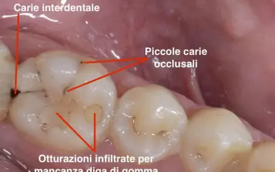 Dente con carie interdentale e piccole carie occlusali. Si nota un puntino nero sul dente, segno di un problema da affrontare.