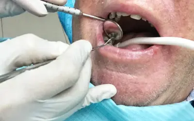 Dentysta usuwa korzeń zęba z ropą, używając lusterka i narzędzi.