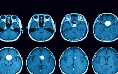 Przekroje mózgu MRI ukazujące guz przysadki, potencjalną przyczynę niedoczynności przysadki mózgowej.