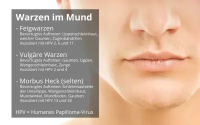 Informationen zu HPV im Mund: Feig-, vulgäre und Morbus Heck-Warzen. Erfahren Sie mehr über die Ursachen und Symptome.