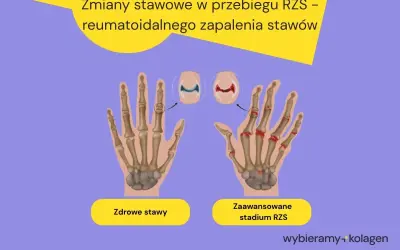 Porównanie zdrowych stawów dłoni z zaawansowanym stadium RZS, gdzie widoczne są zmiany zapalne i uszkodzenia kości.