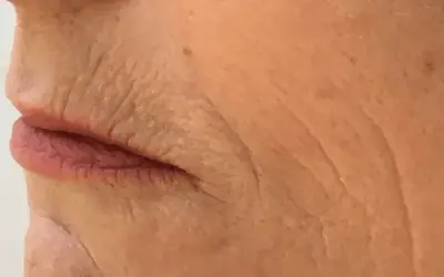Nahaufnahme der Lippen und der Haut einer älteren Person mit tiefen Falten, die auf die Auswirkungen des Rauchens hinweisen. Kleine Pickel sind sichtbar.