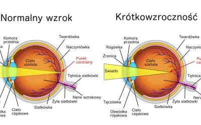 Krótkowzroczność: przyczyny, objawy i jak chronić wzrok?