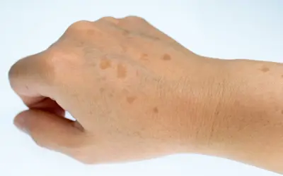 Gros plan sur le dos d'une main montrant plusieurs taches brunes sur la peau, signes du temps ou du soleil.