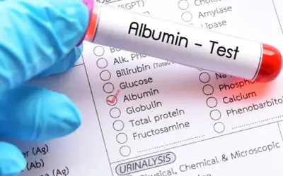 Rękawiczka w niebieskiej rękawiczce trzyma probówkę z napisem "Albumin - Test". Obok zaznaczono "Albumin" na formularzu badań, co sugeruje analizę albuminy w moczu i jej normy.