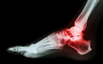 Złamana pięta: Jak długo trwa rehabilitacja? Poznaj realia