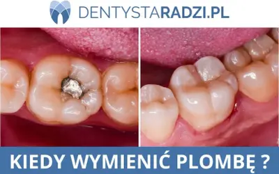 Przed i po: stara plomba metalowa zastąpiona nową, estetyczną. Stomatologia zachowawcza w praktyce.