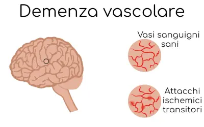 Illustrazione del cervello con un cerchio che indica un'area interessata da vasculopatia cerebrale cronica nell'anziano. Confronto tra vasi sanguigni sani e quelli colpiti da attacchi ischemici transitori.