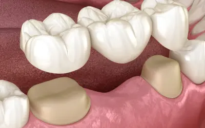 Most porcelanowy na podbudowie metalowej, uzupełniający braki w uzębieniu.