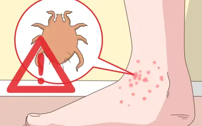 Un pied présente des piqûres rouges, signe d'un orteil qui gratte le soir à cause d'un acarien.
