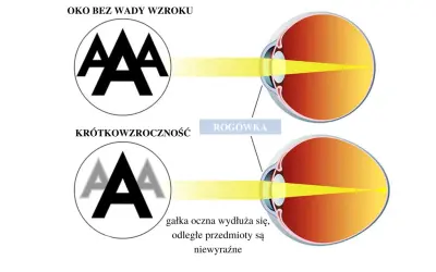 Krótkowzroczność: wydłużona gałka oczna powoduje, że światło skupia się przed siatkówką, obraz jest niewyraźny.