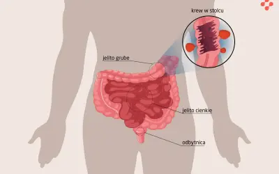 Ilustracja przedstawia jelito grube z widocznymi zmianami, które mogą powodować krew w kale. Powiększony fragment ukazuje krwawiące polipy.