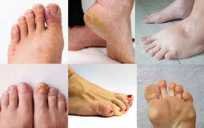 La podologia cos'è? Immagini di piedi con unghie incarnite, talloni screpolati, funghi, calli e gonfiore.