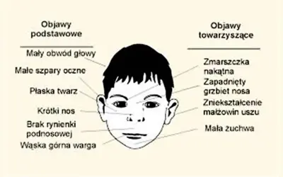 Ilustracja przedstawia twarz dziecka z zaznaczonymi cechami charakterystycznymi dla zespołu FAS: mały obwód głowy, płaska twarz, krótki nos, wąska warga, zmarszczka nakątna, zapadnięty grzbiet nosa.