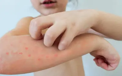 Dziecko drapie swędzące krostki na ramieniu, objawy ospy wietrznej.