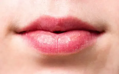 Labios rosados con piel seca y descamada, evidencia de labios quemados por el sol tras un día soleado.