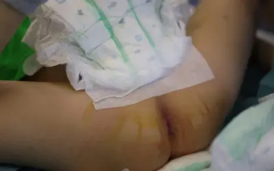 Niemowlę w pieluszce, które 3 latek sika 2 razy dziennie, leży na boku. Widoczne są ślady po wkłuciach.