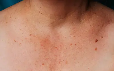 Skóra na dekolcie i szyi z licznymi piegami i plamami wątrobowymi.