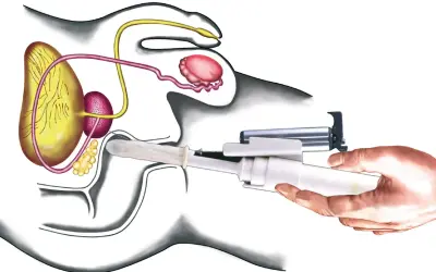 Illustration zeigt eine rektale Untersuchung mit einem Instrument, das in den After eingeführt wird, um die Prostata zu untersuchen.