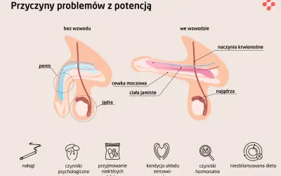 Ilustracja pokazuje budowę penisa bez i we wzwodzie, wyjaśniając przyczyny impotencji. Wymieniono nałogi, czynniki psychologiczne i inne.