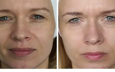 Laser frakcyjny: Kiedy efekty? Pełny harmonogram regeneracji