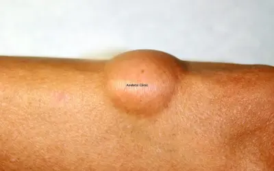 Widoczny na skórze łagodny tłuszczak (lipoma) – okrągłe, cieliste zgrubienie.