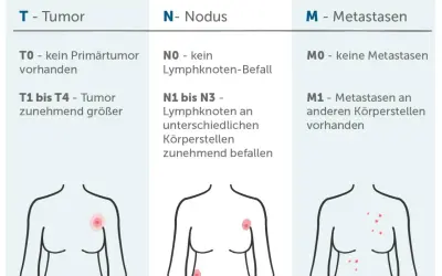 TNM-Klassifikation: Tumorgröße (T), Lymphknotenbefall (N) und Fernmetastasen (M) zur Beurteilung von malignen Tumoren.