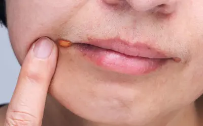 Zajady: Skuteczne leki bez recepty i kiedy do lekarza?