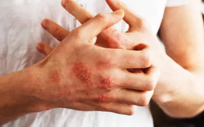 Mani con chiazze rosse e squamose, segno di psoriasi. Nonostante non sia mortale, la psoriasi può avere un impatto devastante sulla qualità della vita.
