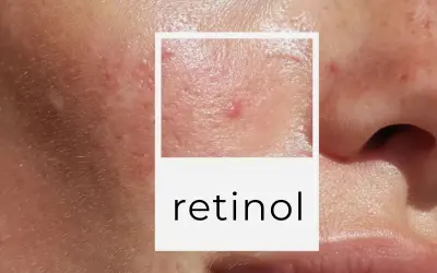 Zbliżenie na skórę z niedoskonałościami, w tym pryszczami i bliznami. W ramce napis "retinol", sugerujący jego działanie.
