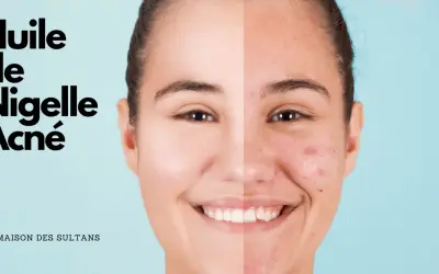 Visage divisé montrant une peau nette et une peau acnéique, avec le texte "Huile de Nigelle Acné".