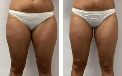 Endermologia: Kiedy efekty? Po 3 sesjach już widać! Pełna przemiana