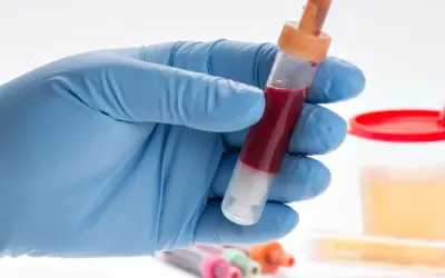 Ręka w niebieskiej rękawiczce trzyma probówkę z krwią. W tle pojemnik z żółtym płynem, sugerującym badanie moczu, gdzie może być obecne białko i krew.