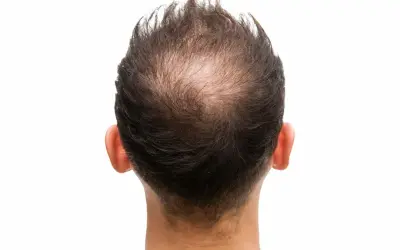 Mann mit Geheimratsecken. Informationen, wie kann man haarausfall stoppen, sind hier relevant.