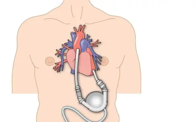 Schemat przedstawia serce z wszczepioną pompą wspomagającą krążenie, ilustrując cykl hemodynamiczny serca.