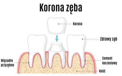 Ilustracja pokazuje proces zakładania korony na ząb. Dwa zdrowe zęby po bokach, a w środku ząb przygotowany do założenia korony, która jest umieszczona nad nim.