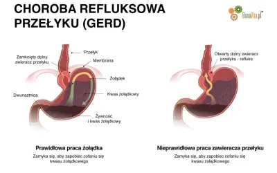 Refluks: Objawy, leczenie, dieta. Odzyskaj komfort!
