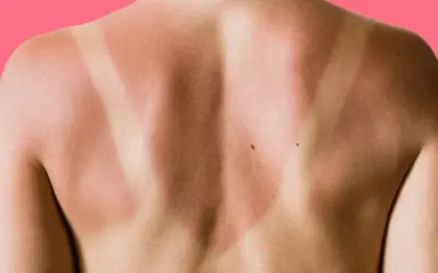 Schiena con evidente abbronzatura a strisce, segno di una giornata al sole con indumenti che hanno lasciato la pelle scoperta in alcune zone.