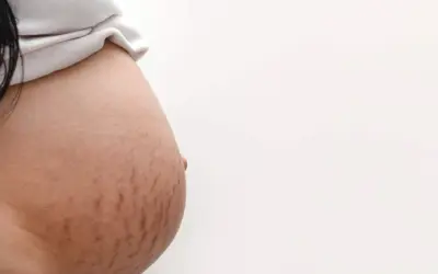 Czerwone rozstępy na brzuchu kobiety, świadectwo pięknej podróży macierzyństwa.
